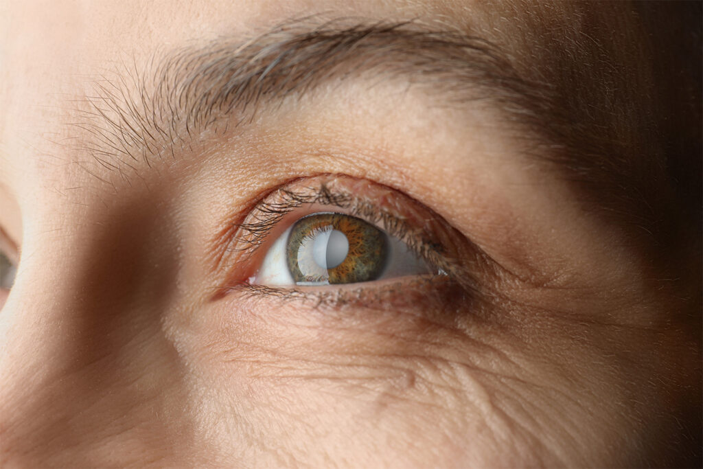 A Complete Guide to Cataracts Surgery: Types, Benefits, and Recovery