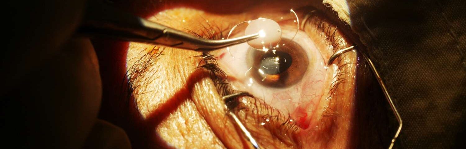 A Complete Guide to Cataracts Surgery: Types, Benefits, and Recovery