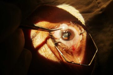 A Complete Guide to Cataracts Surgery: Types, Benefits, and Recovery